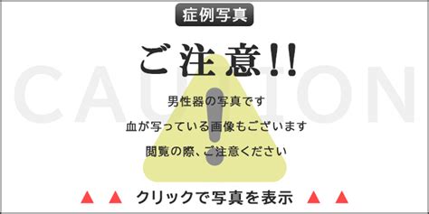 改造チンポとは|長茎術・増大術の症例写真を専門医が年齢別（20代〜70代まで…